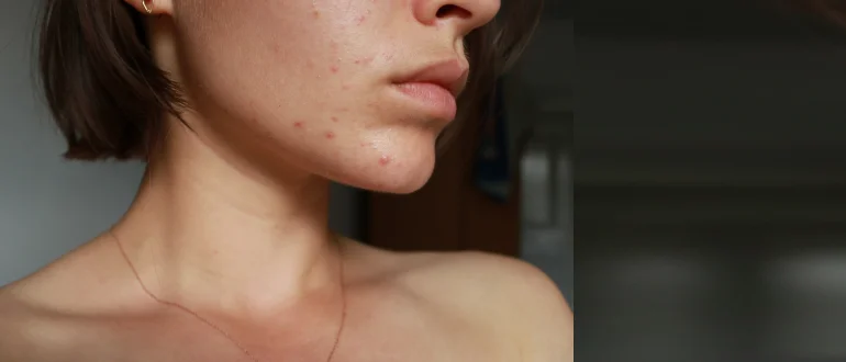 Acne Breakout