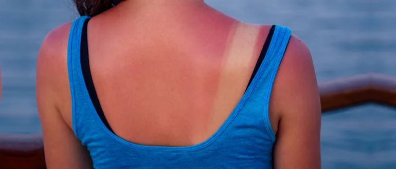 Sun Allergy