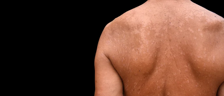 Tinea Versicolor