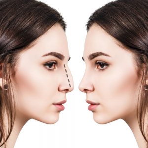 Pros and cons of a non-surgical nose job